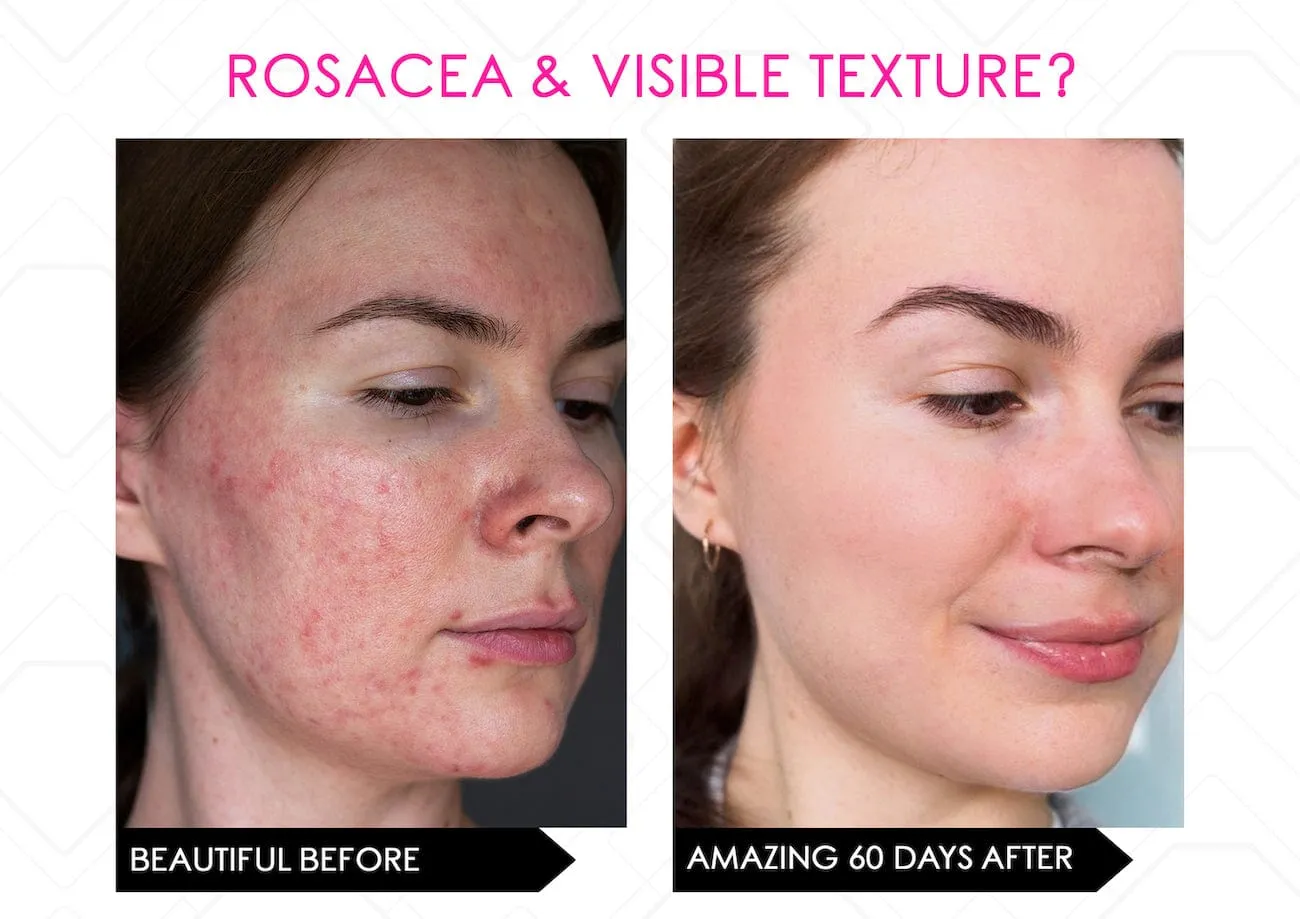 Limited Stock* Skin Secrets Pro Kit Amazing LED Mask - Red Led 7 in 1 Treatments FDA Cleared